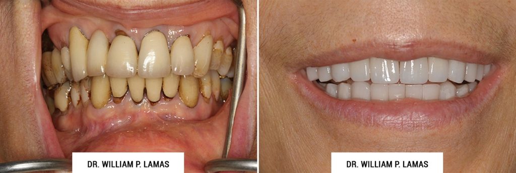 All-on-4 Dental Implants Before & After Photo - William P. Lamas, DMD - Periodontics & Dental Implants. Address: 2645 SW 37th Ave Suite 304, Miami, FL 33133 Phone: (305) 440-4114