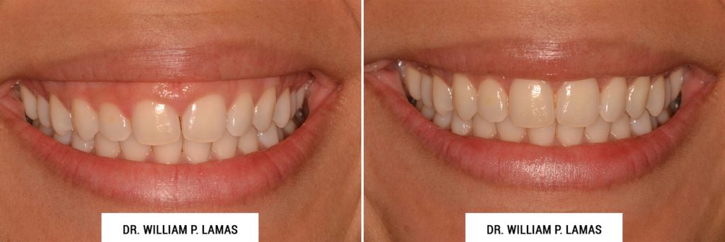 Crown Lengthening Before & After Photo - William P. Lamas, DMD - Periodontics & Dental Implants. Address: 2645 SW 37th Ave Suite 304, Miami, FL 33133 Phone: (305) 440-4114