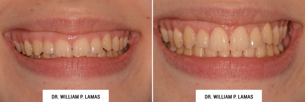Crown Lengthening Before & After Photo - William P. Lamas, DMD - Periodontics & Dental Implants. Address: 2645 SW 37th Ave Suite 304, Miami, FL 33133 Phone: (305) 440-4114