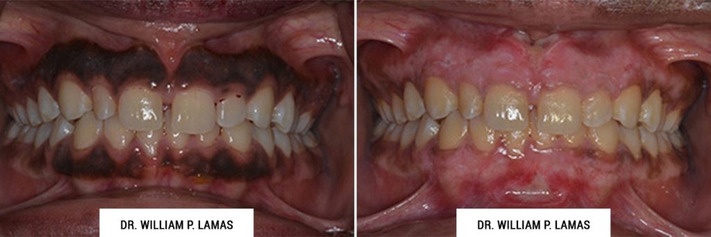 Dark Gum Depigmentation Before & After Photo - William P. Lamas, DMD - Periodontics & Dental Implants. Address: 2645 SW 37th Ave Suite 304, Miami, FL 33133 Phone: (305) 440-4114