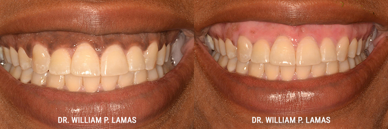 Dark Gum Depigmentation Before & After Photo - William P. Lamas, DMD - Periodontics & Dental Implants.