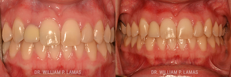 Gum Grafting Treatment Before & After Photo - William P. Lamas, DMD - Periodontics & Dental Implants