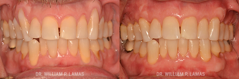 Gum Grafting Treatment Before & After Photo - William P. Lamas, DMD - Periodontics & Dental Implants