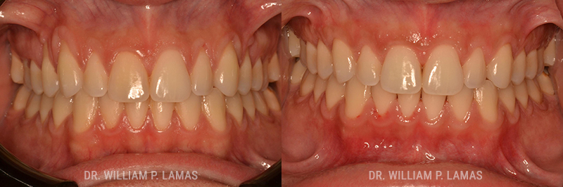 Gum Grafting Treatment Before & After Photo - William P. Lamas, DMD - Periodontics & Dental Implants