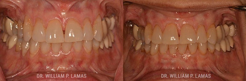 Gum Grafting Treatment Before & After Photo - William P. Lamas, DMD - Periodontics & Dental Implants