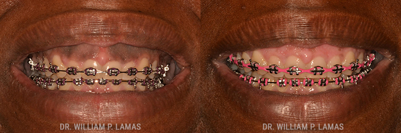 Dark Gum Depigmentation Before & After Photo - William P. Lamas, DMD - Periodontics & Dental Implants.