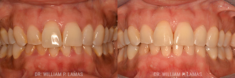 Dental Teeth Cleaning Before & After Photo - William P. Lamas, DMD - Periodontics & Dental Implants.
