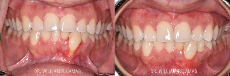 Gum Grafting Treatment Before & After Photo - William P. Lamas, DMD - Periodontics & Dental Implants