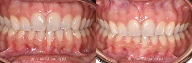 Gum Grafting Treatment Before & After Photo - William P. Lamas, DMD - Periodontics & Dental Implants