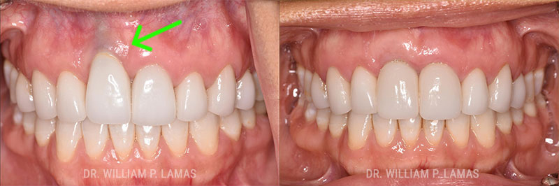 Dental Implants Before & After Photo - William P. Lamas, DMD - Periodontics & Dental Implants.