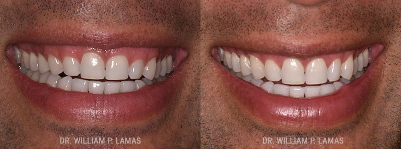 Gummy Smile Correction Before & After Photo - William P. Lamas, DMD - Periodontics & Dental Implants.