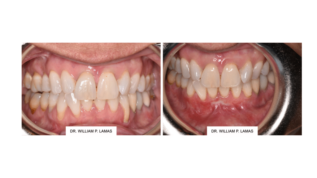 gum ression treatment in miami