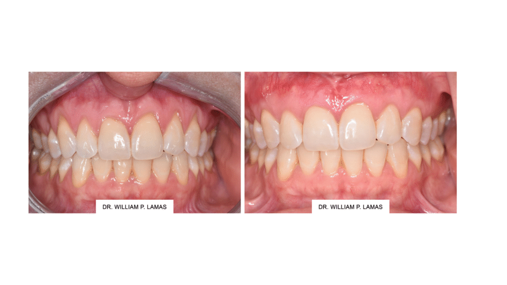 gum ression treatment in miami